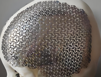 Medicīniskā titāna sakausējuma sieta cena